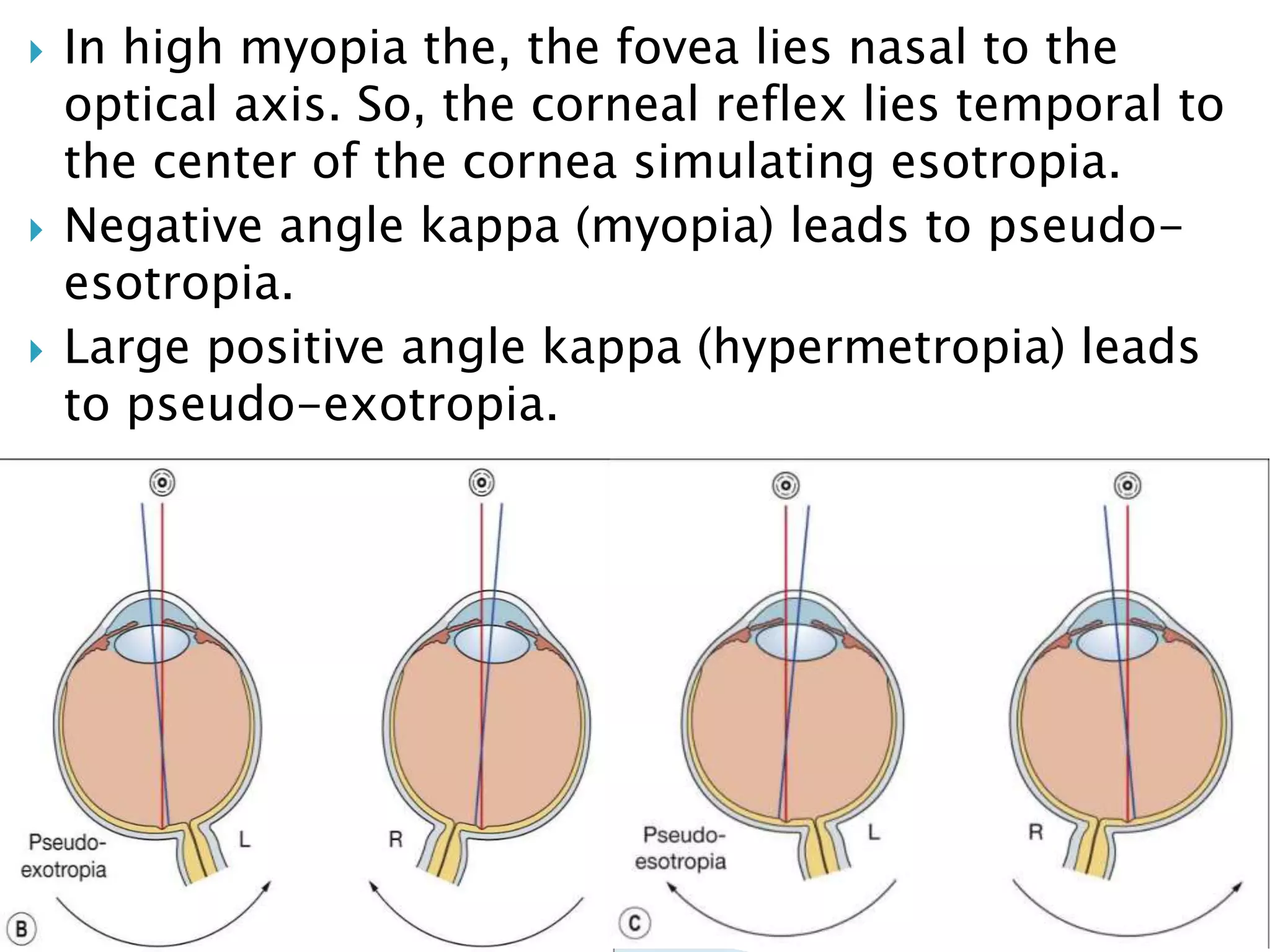  In high myopia the, the fovea lies nasal to the
optical axis. So, the corneal reflex lies temporal to
the center of the cornea simulating esotropia.
 Negative angle kappa (myopia) leads to pseudo-
esotropia.
 Large positive angle kappa (hypermetropia) leads
to pseudo-exotropia.
 