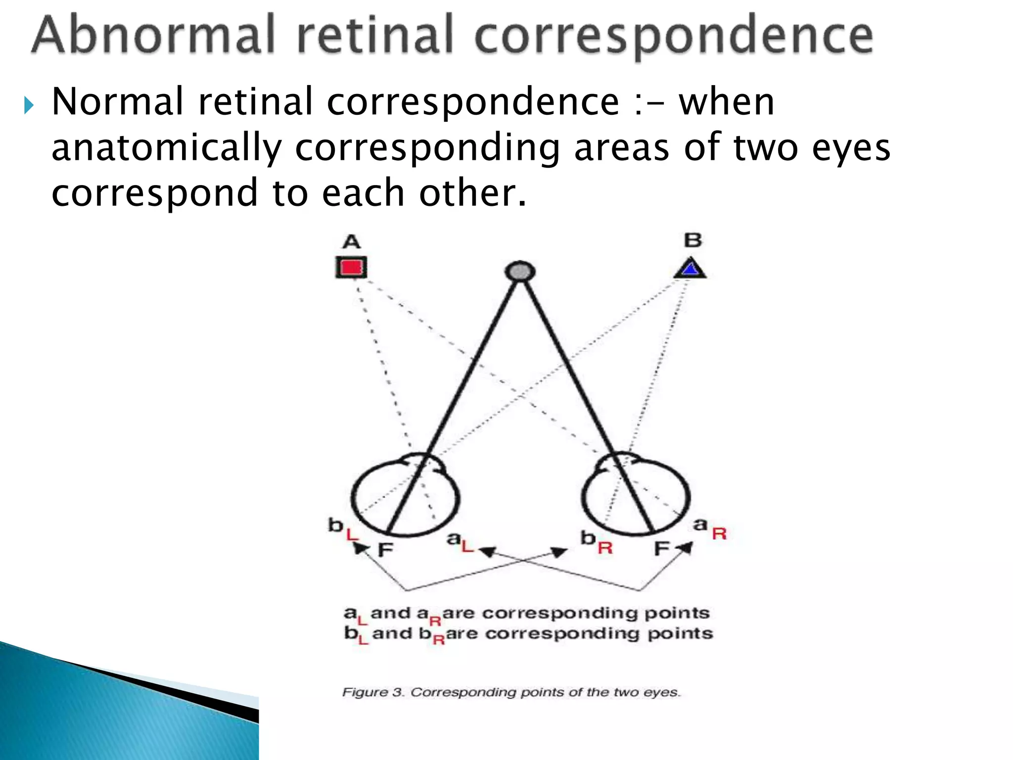  Normal retinal correspondence :- when
anatomically corresponding areas of two eyes
correspond to each other.
 