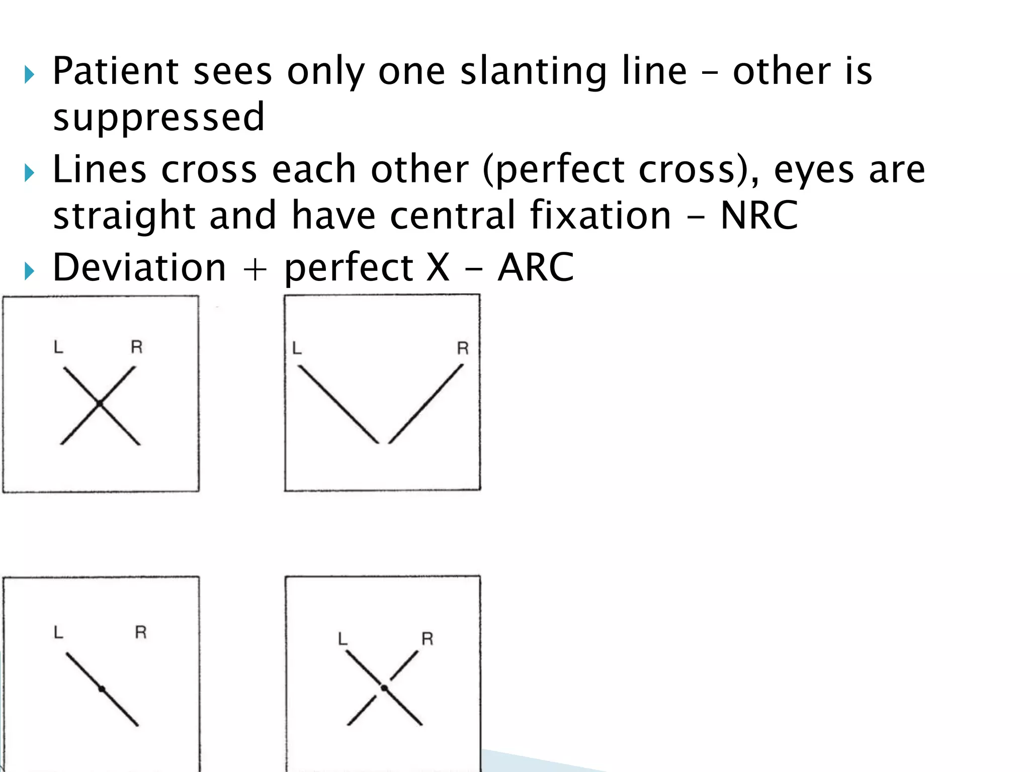  Patient sees only one slanting line – other is
suppressed
 Lines cross each other (perfect cross), eyes are
straight and have central fixation - NRC
 Deviation + perfect X - ARC
 