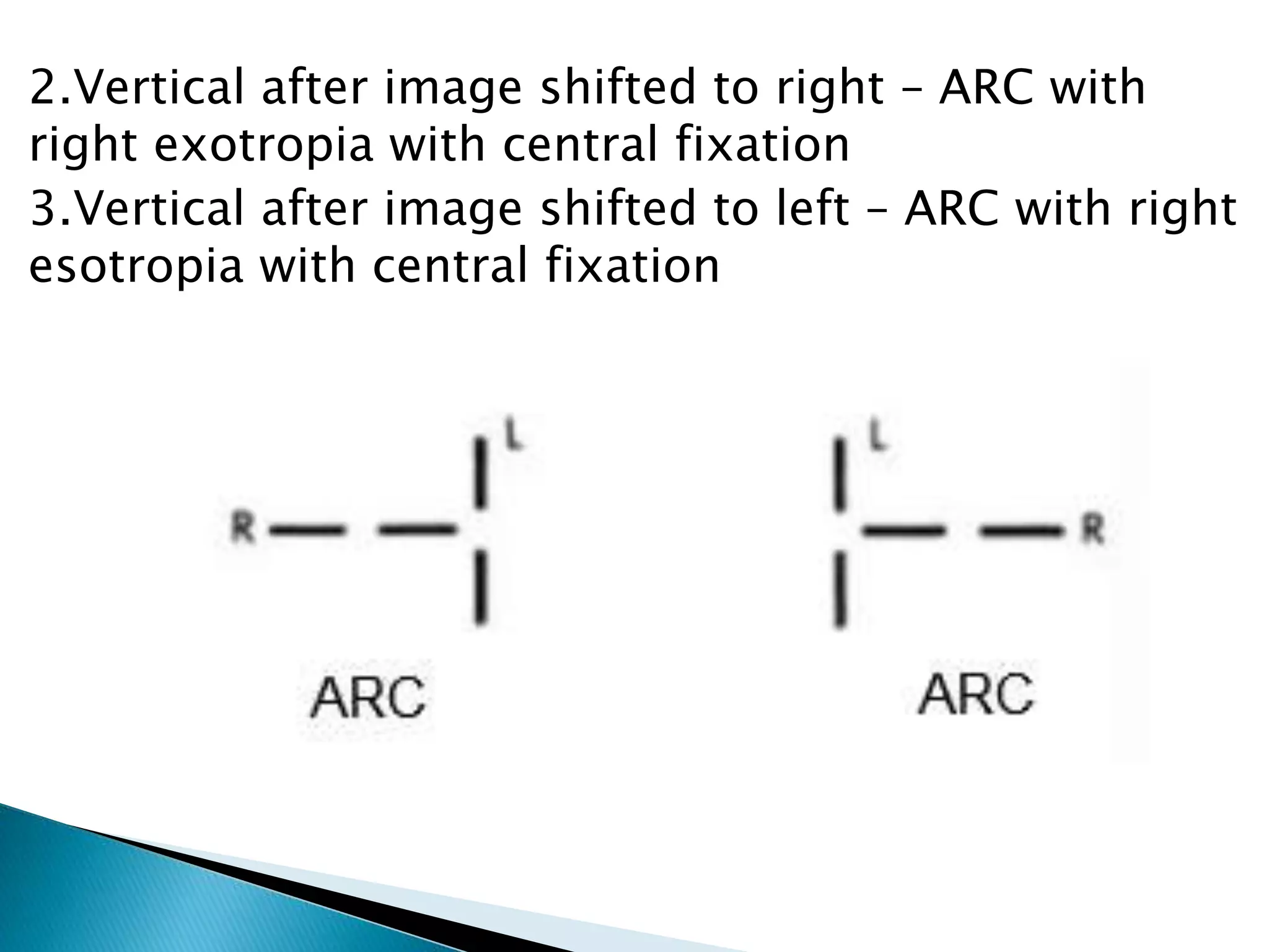 2.Vertical after image shifted to right – ARC with
right exotropia with central fixation
3.Vertical after image shifted to left – ARC with right
esotropia with central fixation
 