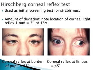  Used as initial screening test for strabismus.
 Amount of deviation: note location of corneal light
reflex 1 mm = 7° or 15Δ
Corneal reflex at border Corneal reflex at limbus
of pupil = 15° = 45°
 