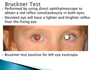  Performed by using direct ophthalmoscope to
obtain a red reflex simultaneously in both eyes.
 Deviated eye will have a lighter and brighter reflex
than the fixing eye.
 Bruckner test positive for left eye esotropia
 