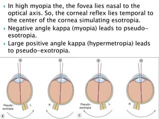  In high myopia the, the fovea lies nasal to the
optical axis. So, the corneal reflex lies temporal to
the center of the cornea simulating esotropia.
 Negative angle kappa (myopia) leads to pseudo-
esotropia.
 Large positive angle kappa (hypermetropia) leads
to pseudo-exotropia.
 