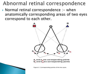  Normal retinal correspondence :- when
anatomically corresponding areas of two eyes
correspond to each other.
 