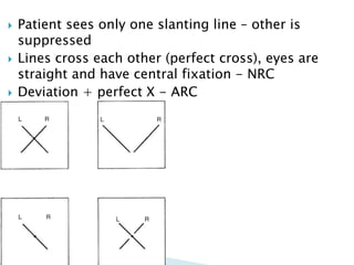  Patient sees only one slanting line – other is
suppressed
 Lines cross each other (perfect cross), eyes are
straight and have central fixation - NRC
 Deviation + perfect X - ARC
 