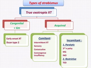 Types of strabismus
True exotropia XT
Congenital
< 6m
Early onset XT
Duan type 2
Acquired
Comitant:
Intermittent XT
Sensor...