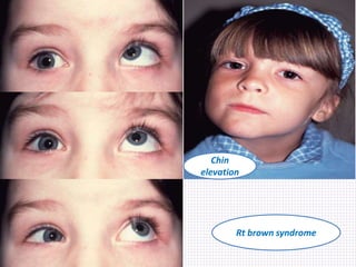 Rt brown syndrome
Chin
elevation
 