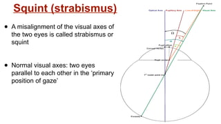 Squint eye case presentation opthalmology | PPTX
