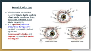 Squint eye case presentation opthalmology | PPTX