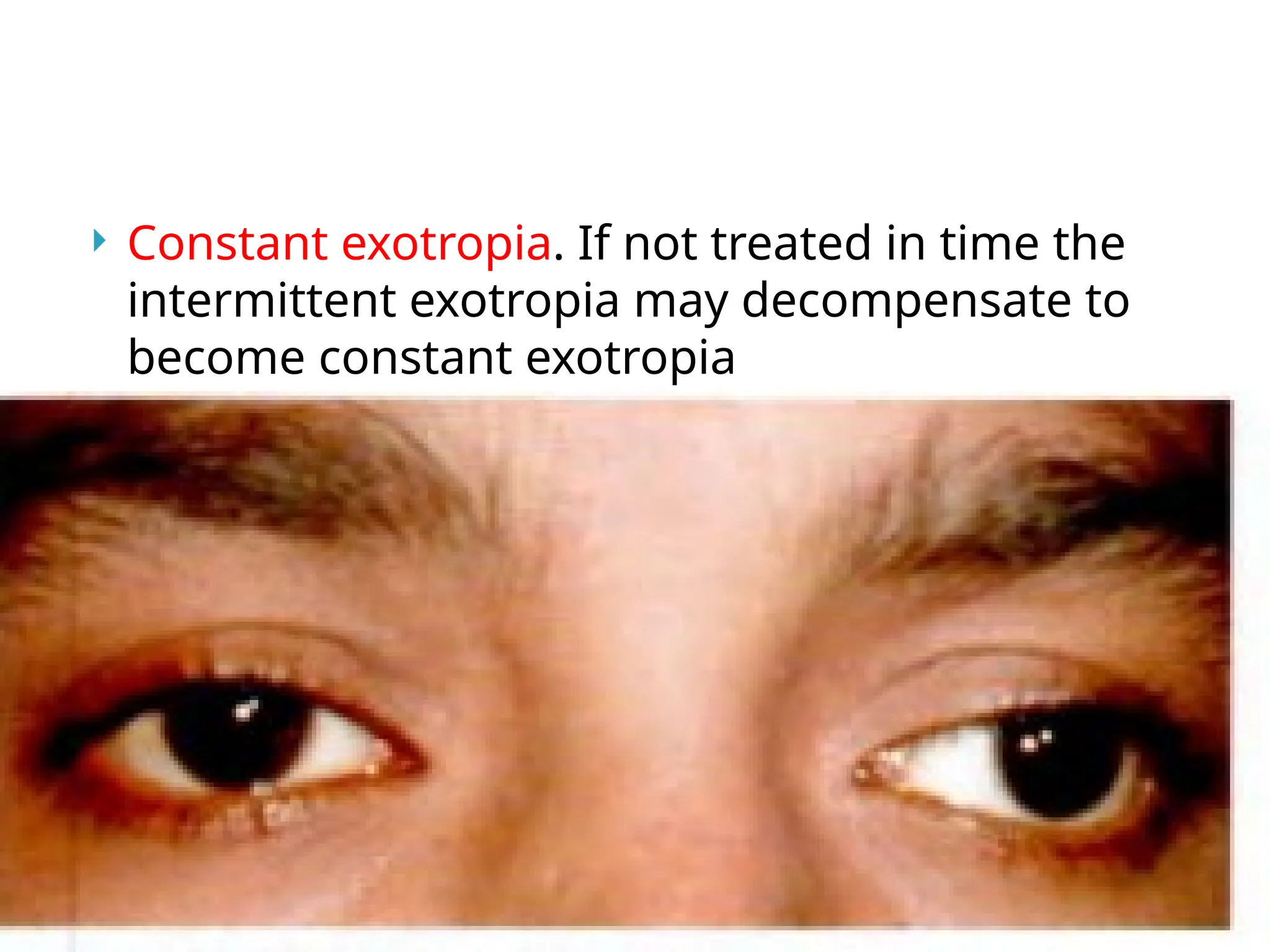  Constant exotropia. If not treated in time the
intermittent exotropia may decompensate to
become constant exotropia
 