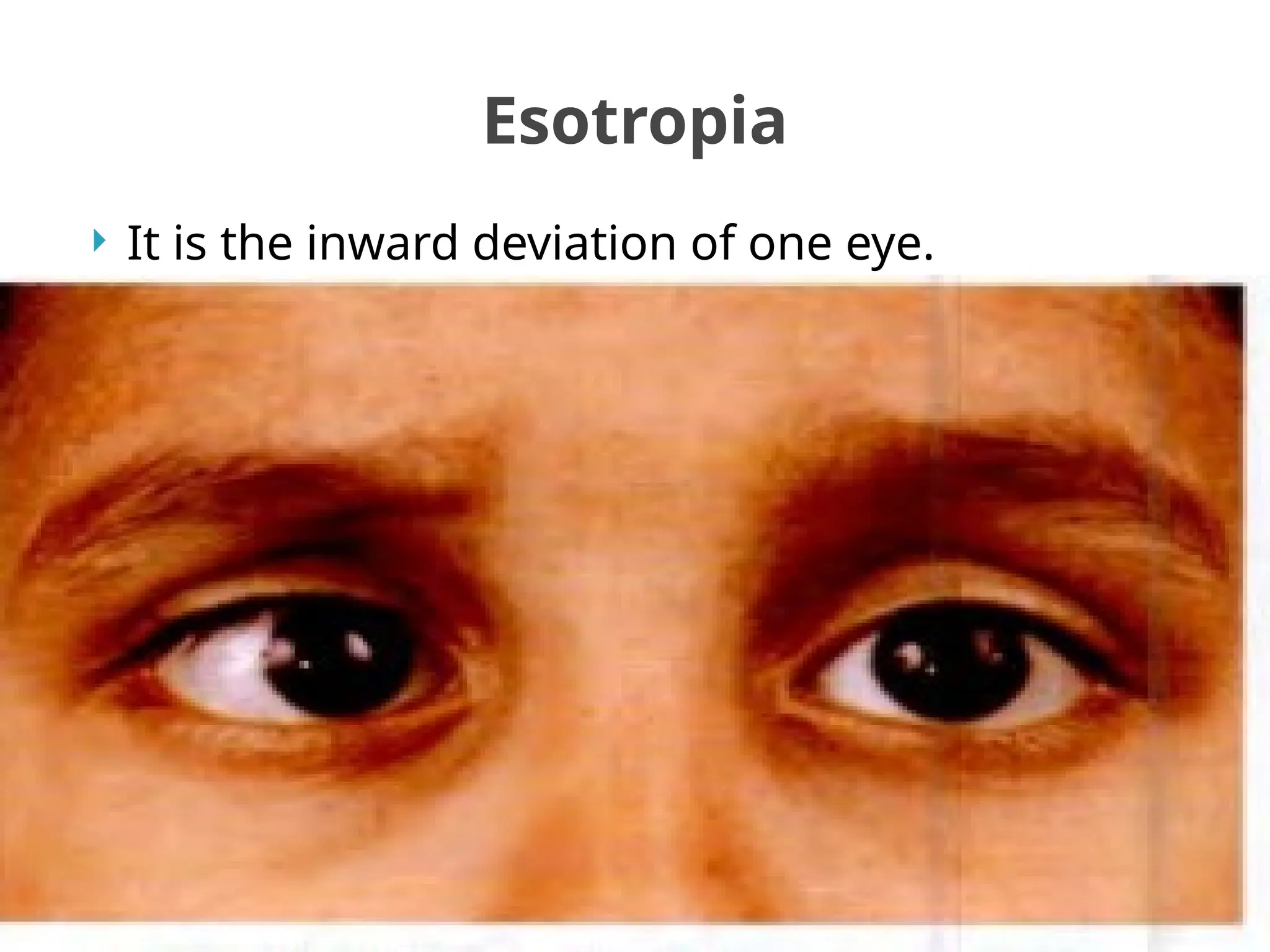  It is the inward deviation of one eye.
Esotropia
 