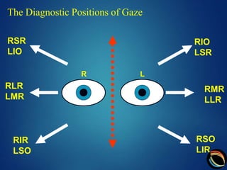 squint assessment optom Anamul haq | PPTX