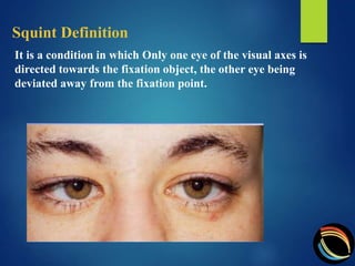 squint assessment optom Anamul haq | PPT