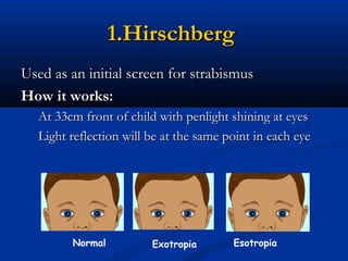 Hirschberg Examples Squint assessment | PPT