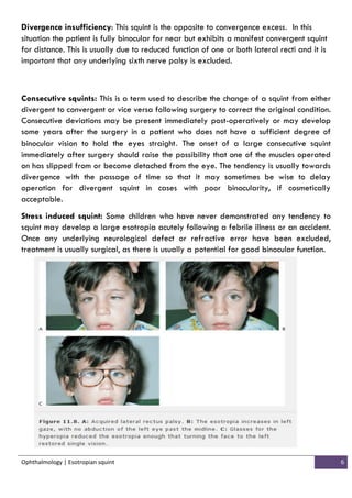 Corrected Squints Squint esotropia | PDF