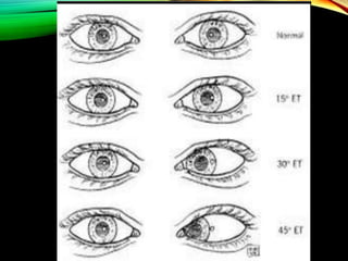 Visual Squint Clinical examination of squint | PPTX