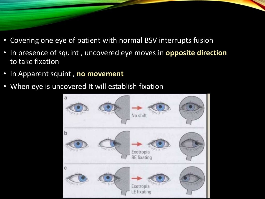 Clinical examination of squint