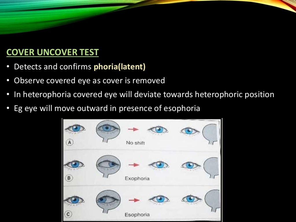 Clinical examination of squint