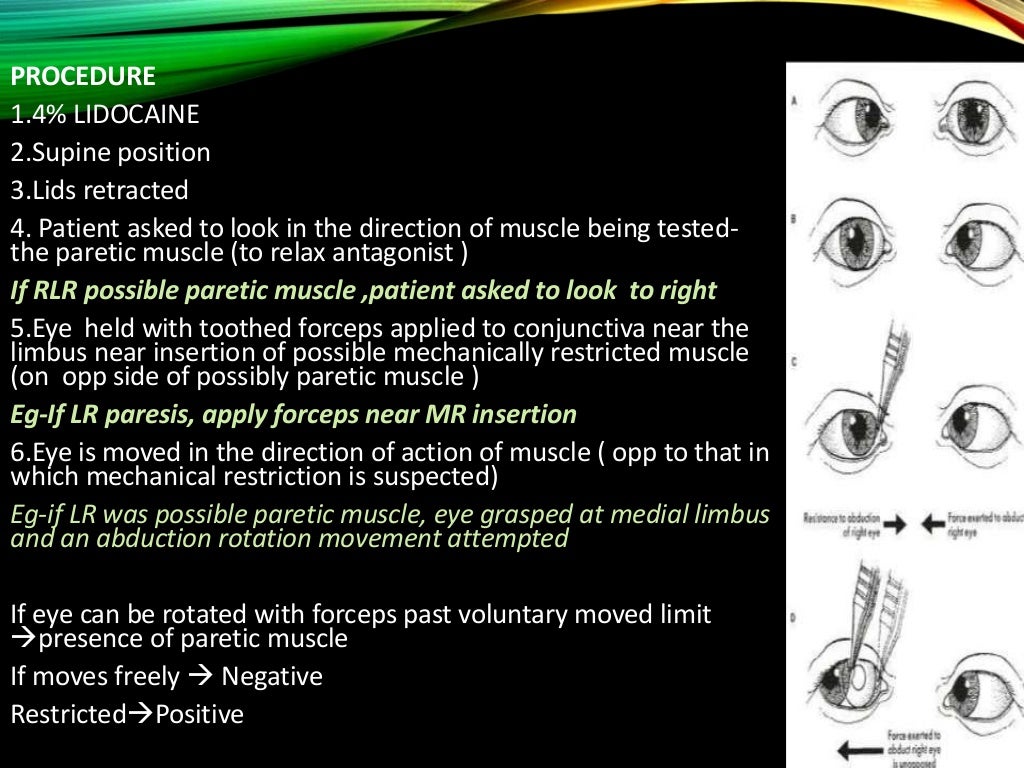 Clinical examination of squint