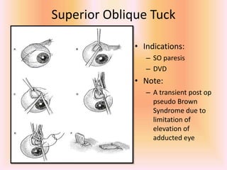 Superior Oblique Tuck
• Indications:
– SO paresis
– DVD
• Note:
– A transient post op
pseudo Brown
Syndrome due to
limitation of
elevation of
adducted eye
 