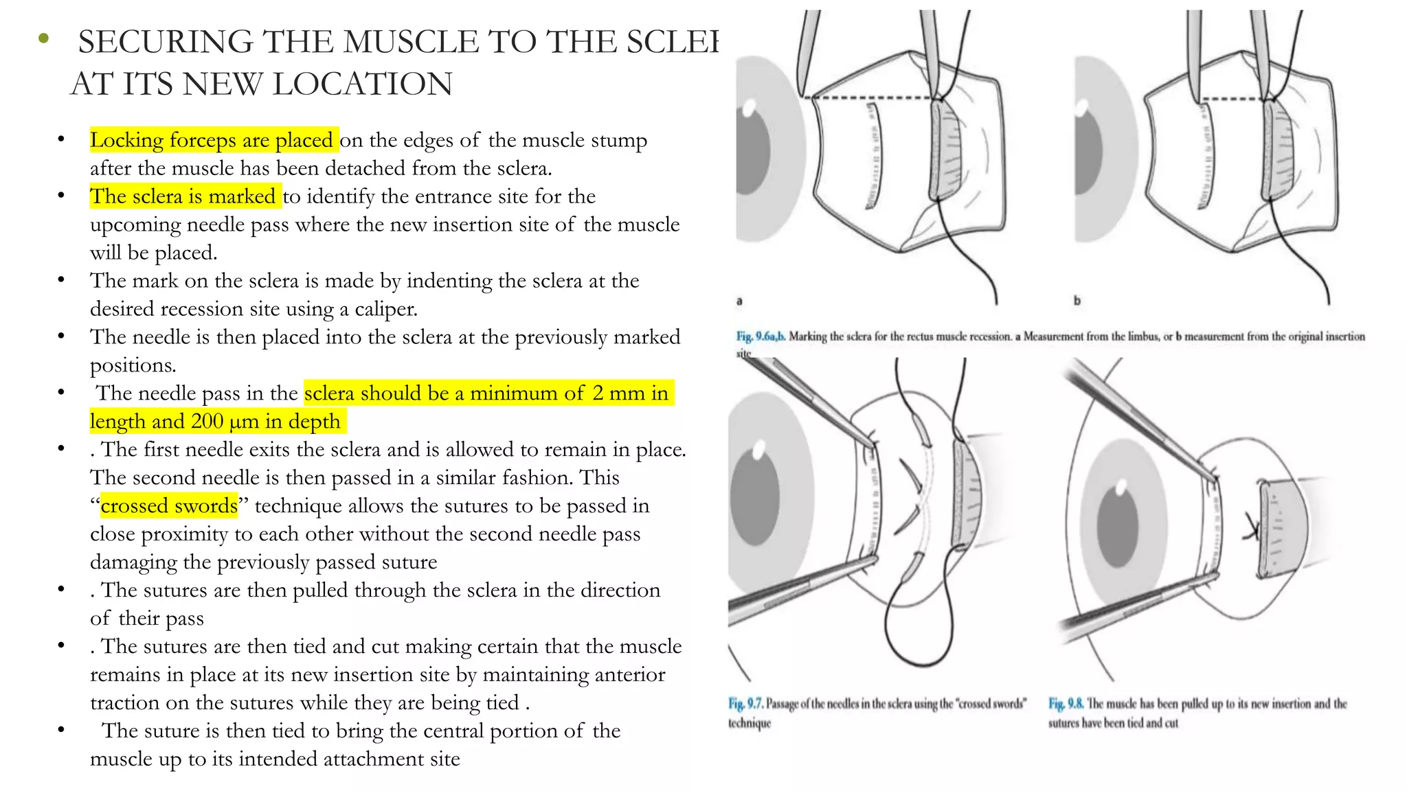Squint surgeries | PPT