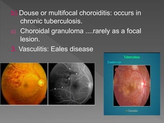 b) Douse or multifocal choroiditis: occurs in
chronic tuberculosis.
c) Choroidal granuloma ....rarely as a focal
lesion.
3. Vasculitis: Eales disease
 