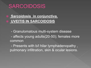  Sarcoidosis in conjunctiva.
 UVEITIS IN SARCOIDOSIS
- Granulomatous multi-system disease
- affects young adults(20-50); females more
common
- Presents with b/l hilar lymphadenopathy ,
pulmonary infiltration, skin & ocular lesions.
 