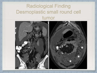Radiological Finding
Desmoplastic small round cell
tumor
 