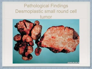 Pathological Findings
Desmoplastic small round cell
tumor
 