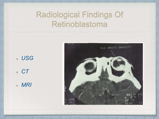 Radiological Findings Of
Retinoblastoma
USG
CT
MRI
 