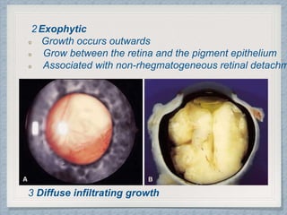 2Exophytic
Growth occurs outwards
Grow between the retina and the pigment epithelium
Associated with non-rhegmatogeneous retinal detachm
3 Diffuse infiltrating growth
 
