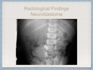 Radiological Findings
Neuroblastoma
 