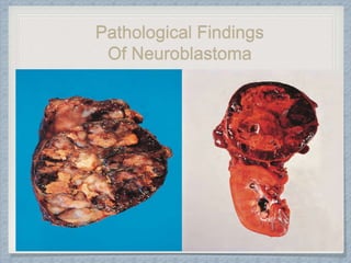 Pathological Findings
Of Neuroblastoma
 