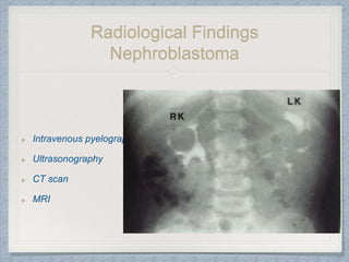 Radiological Findings
Nephroblastoma
Intravenous pyelography
Ultrasonography
CT scan
MRI
 