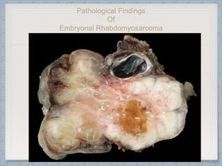 Pathological Findings
Of
Embryonal Rhabdomyosarcoma
 