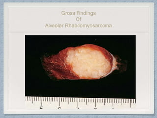 Gross Findings
Of
Alveolar Rhabdomyosarcoma
 