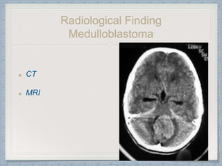 Radiological Finding
Medulloblastoma
CT
MRI
 