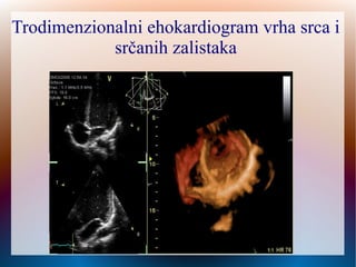 Trodimenzionalni ehokardiogram vrha srca i
srčanih zalistaka
 