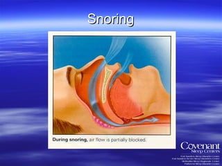 Snoring 