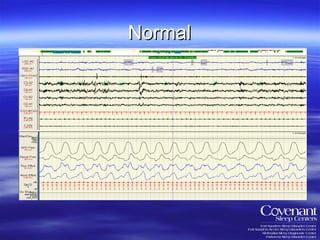Normal 