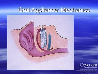 Oral Appliance: Mechanics 