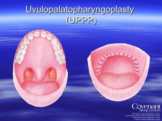 Uvulopalatopharyngoplasty  (UPPP) 
