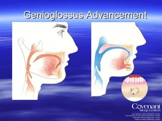 Genioglossus Advancement 
