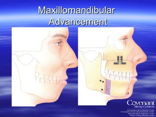Maxillomandibular  Advancement 