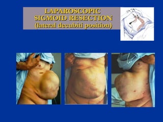 LAPAROSCOPIC
SIGMOID RESECTION
(lateral decubiti position)

 