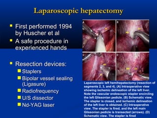 Laparoscopic hepatectomy
 First performed 1994


by Huscher et al
A safe procedure in
experienced hands

 Resection devices:
 Staplers
 Bipolar vessel sealing
(Ligasure)
 Radiofrequency
 U/S dissector
 Nd-YAG laser

Laparoscopic left hemihepatectomy (resection of
segments 2, 3, and 4). (A) Intraoperative view
showing ischemic delineation of the left liver.
Note the vascular endoscopic stapler encircling
the left Glissonian pedicle. (B) Schematic view.
The stapler is closed, and ischemic delineation
of the left liver is obtained. (C) Intraoperative
view. The stapler is fired, and the left main
Glissonian pedicle is transected (arrows). (D)
Schematic view. The stapler is fired

 