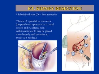 RT. KIDNEY RESECTION
• Subxiphoid port (D) - liver retraction
Trocar A - parallel to vena cava
(perpendicular approach to rt. renal
vessels and rt. adrenal vein –
additional trocar E may be placed
more laterally and posterior to
trocar A if needed.)
•

D

C

E

A

B

 