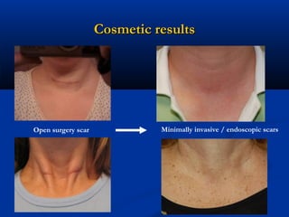 Cosmetic results

Open surgery scar

Minimally invasive / endoscopic scars

 
