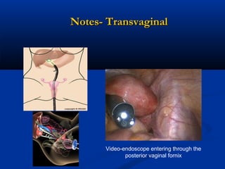 Notes- Transvaginal

Video-endoscope entering through the
posterior vaginal fornix

 
