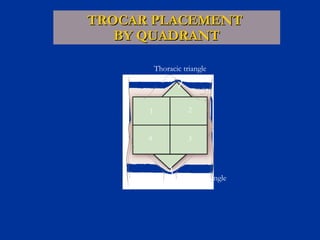 TROCAR PLACEMENT
BY QUADRANT
Thoracic triangle

1

2

4

3

Pelvic triangle

 